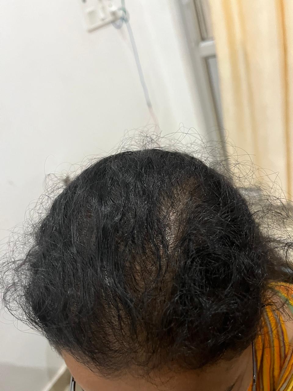 After hair GFC treatment