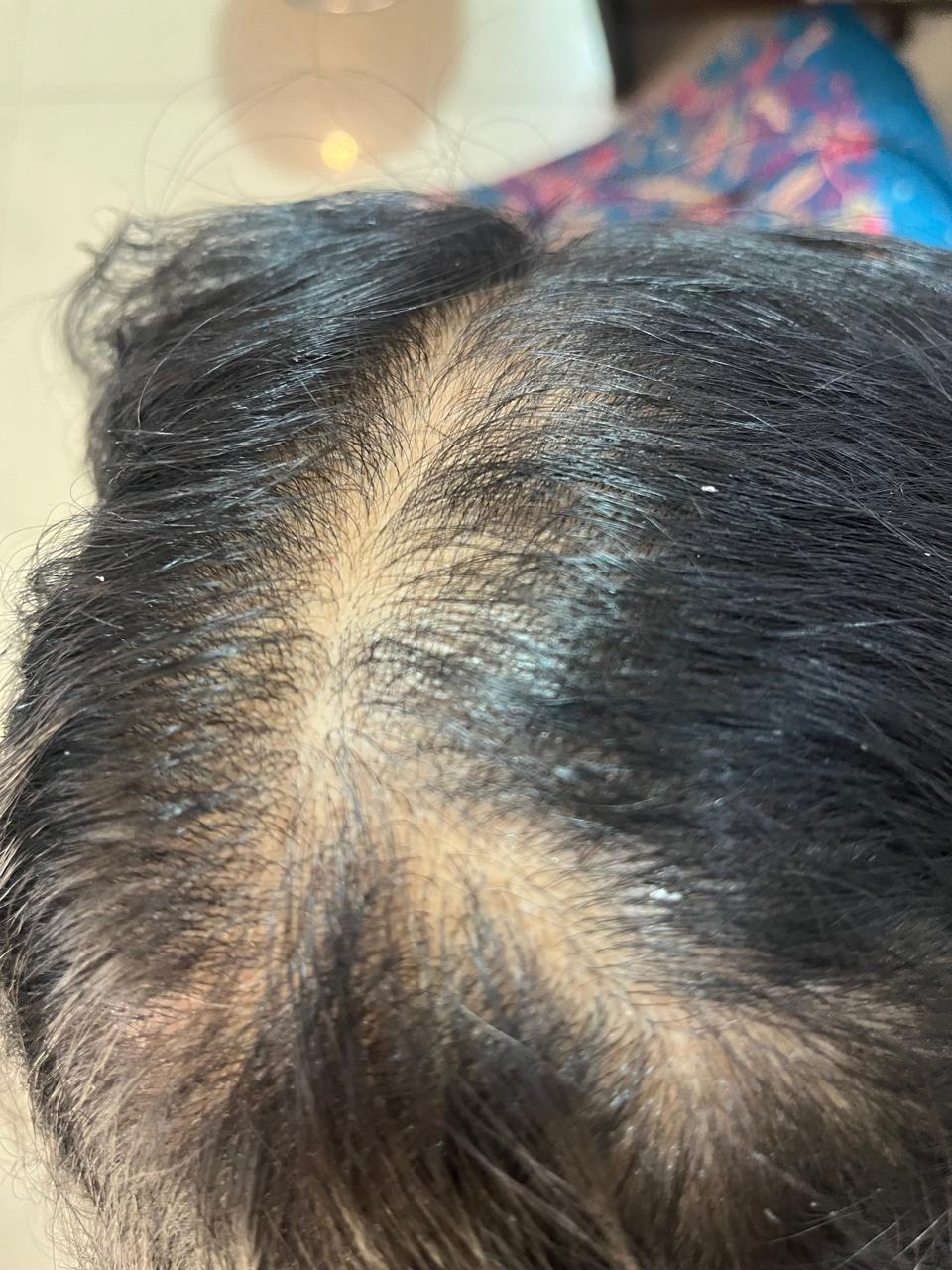 Before hair GFC treatment