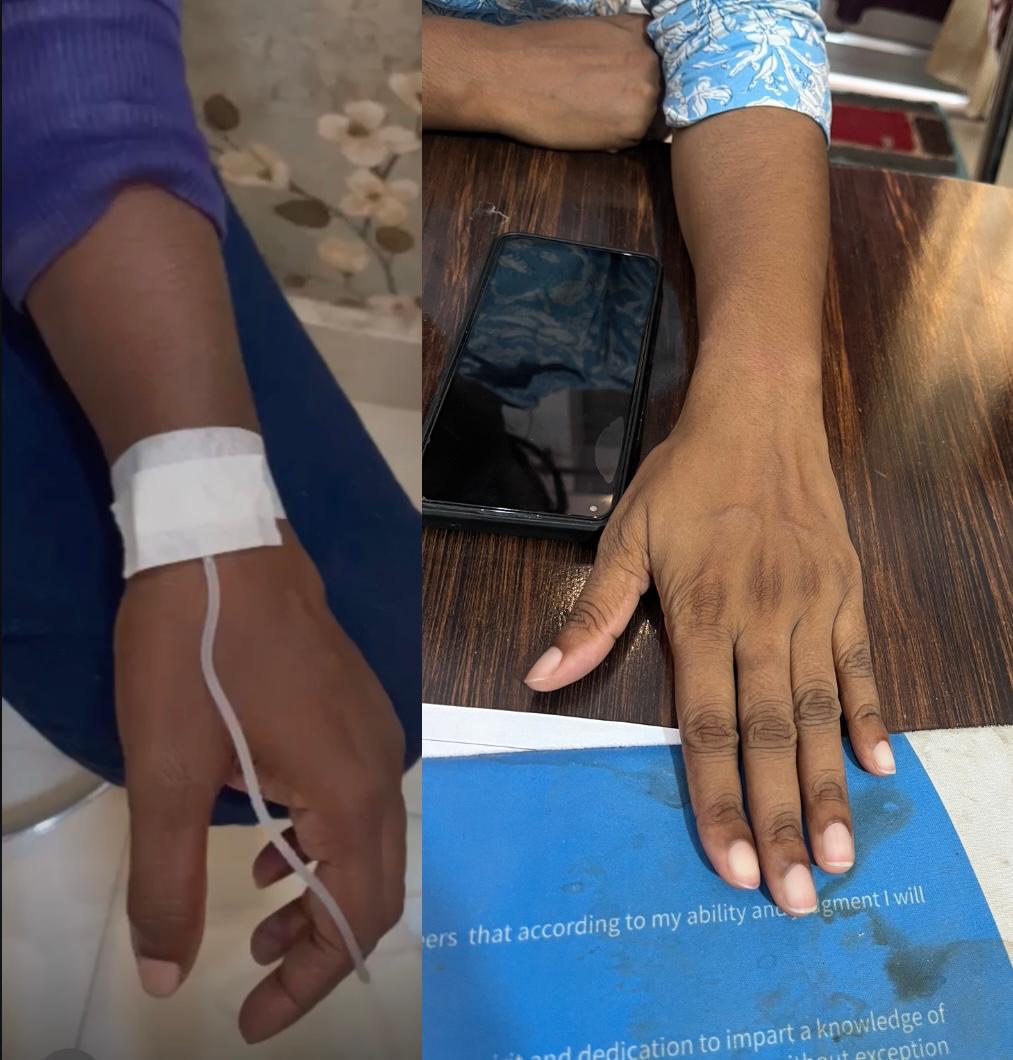 Glutathione skin brightening